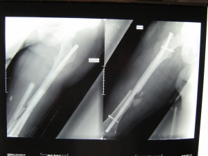 radioavant apres l'operation2